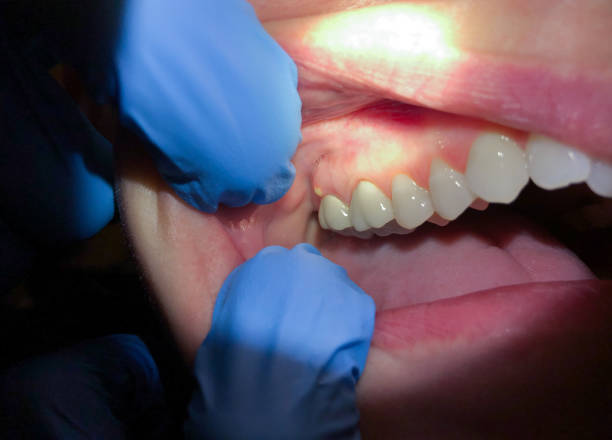 Emergency Gum Pain Relief in AL